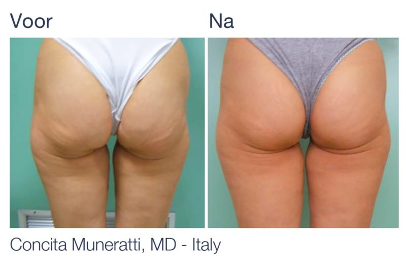Cellulite Treatment - NuEra Tight® - Kazem Aesthetica